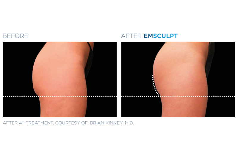 EmSculpt for Buttocks - EmSculpt Buttocks Transformation 2 - Pure Skin Beauty