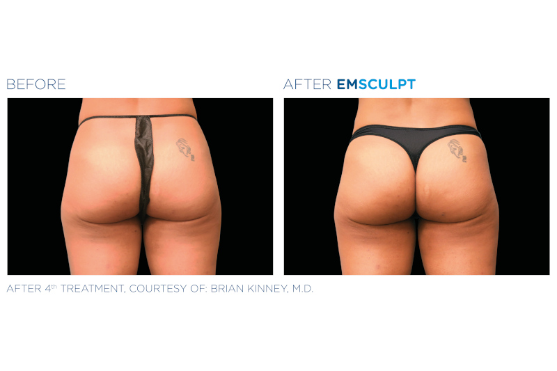 Gallery - EmSculpt Buttocks Transformation 1 - Pure Skin Beauty