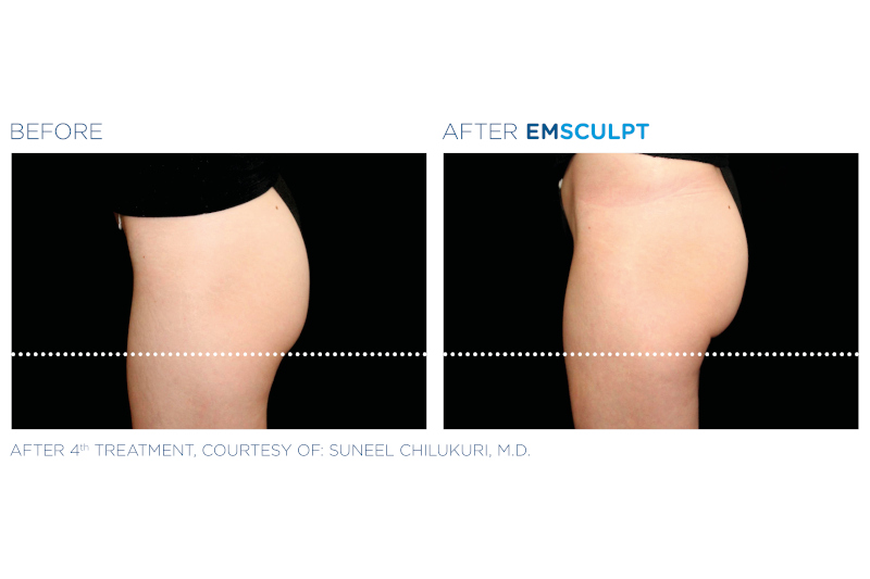 Gallery - EmSculpt Buttocks Transformation 3 - Pure Skin Beauty