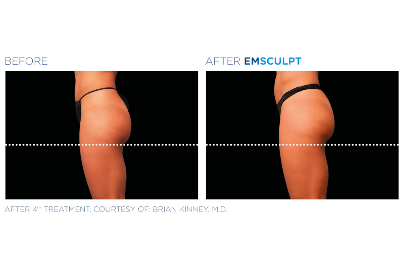 Gallery - EmSculpt Buttocks Transformation 4 - Pure Skin Beauty