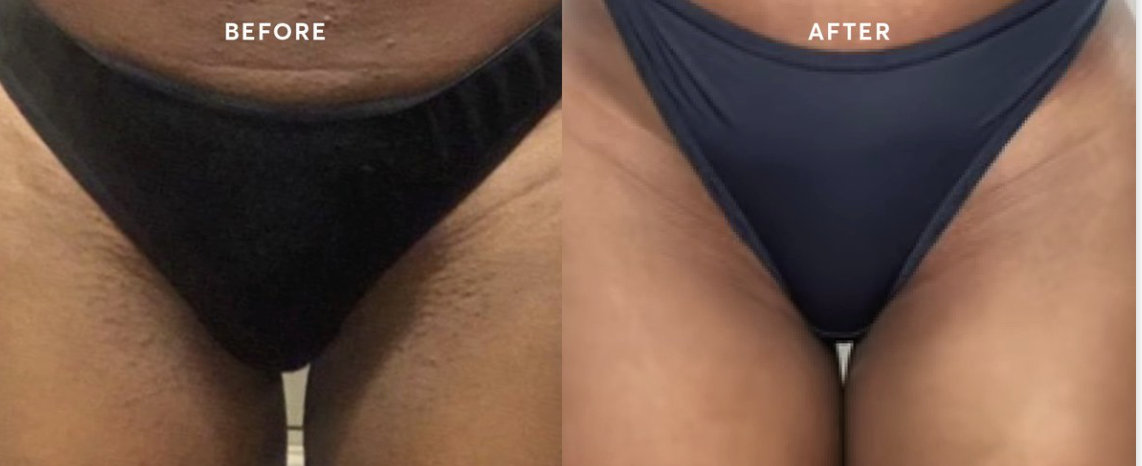 bi laser hair removal