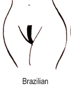 brazilian laser hair removal