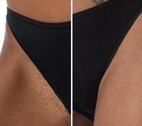 pureskin beauty bikini laser hair removal