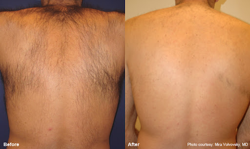 back laser removal before and after result