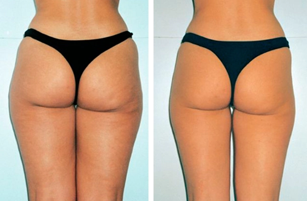butt laser hair - before and after